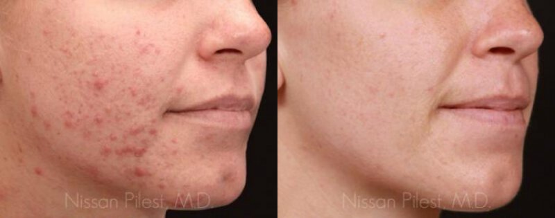 Irvine Acne Laser Therapy Before & After