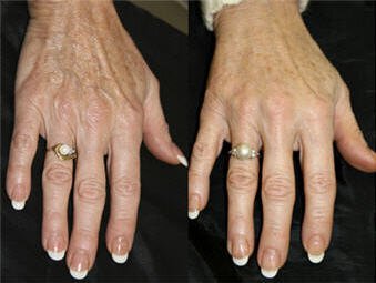 Irvine Hand Treatment patient before and after