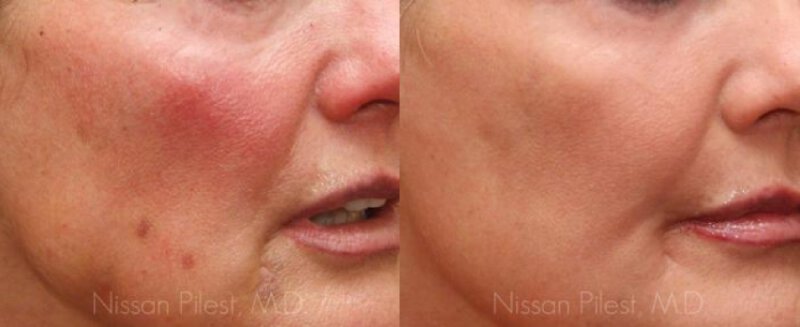 Fractional CO2 Specialist - Irvine, CA: Cosmetic Laser Center of