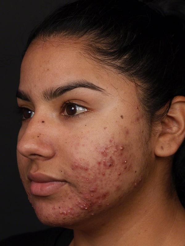 Acne Before & After Image