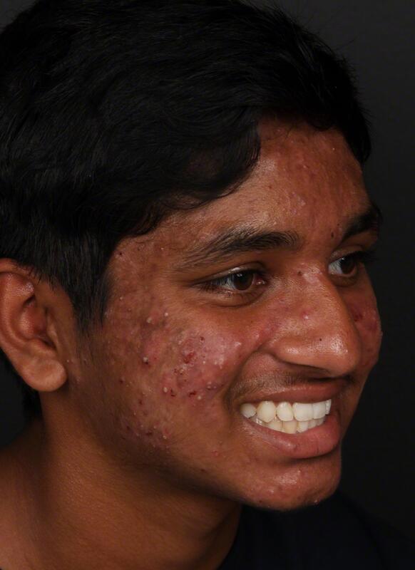 Acne Before & After Image