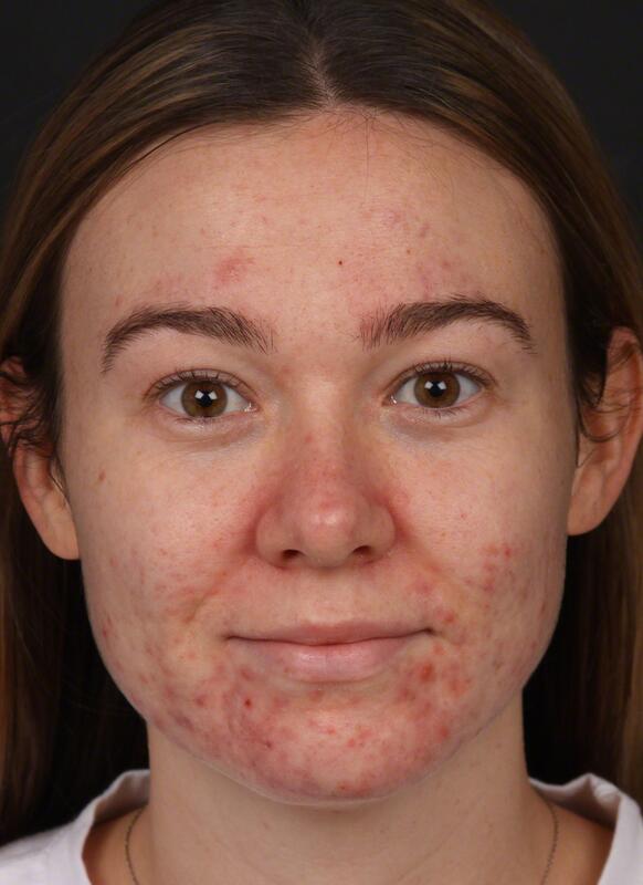 Acne Before & After Image